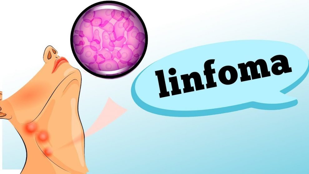 linfoma descubra os sintomas e fatores de risco maxresdefault 3