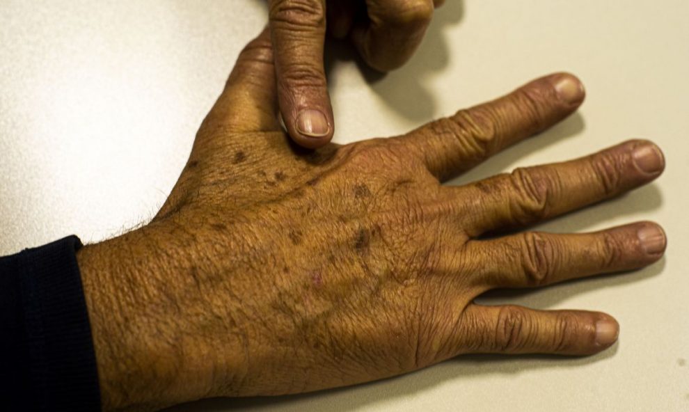 sociedade medica lanca campanha sobre prevencao do cancer de pele melanoma cutaneo abr 200522 1