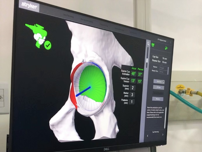 strongunimed criciuma adquire primeiro robo para cirurgia ortopedica de scstrong ortopedia unimed robo mako 6