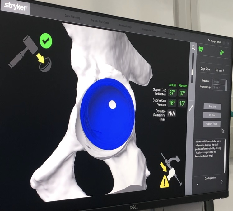 strongunimed criciuma adquire primeiro robo para cirurgia ortopedica de scstrong ortopedia unimed robo mako 7