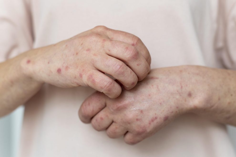 doencas da pele tendem aumentar nos periodos de seca e friagem skin allergy person s arm