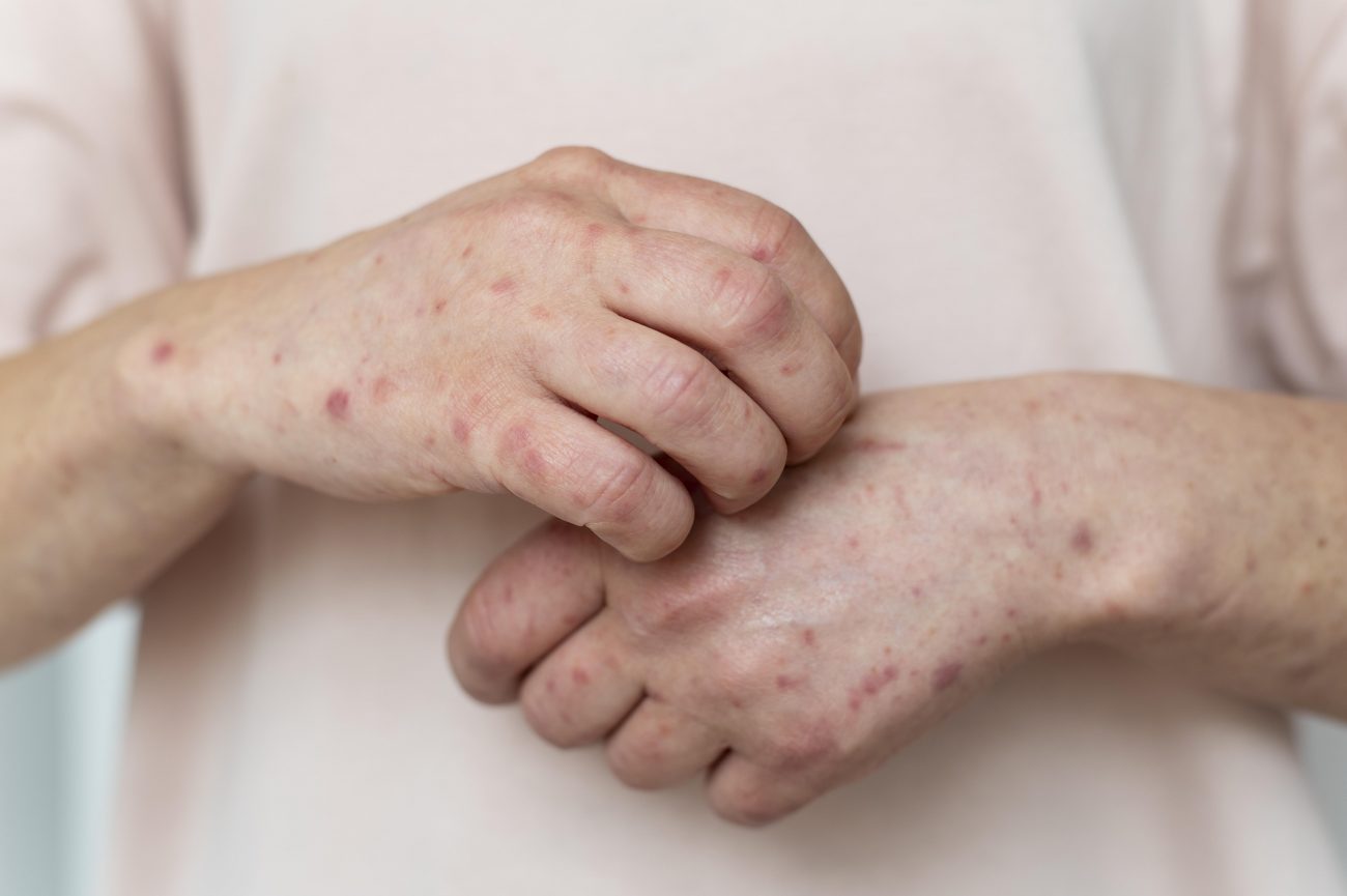 doencas da pele tendem aumentar nos periodos de seca e friagem skin allergy person s arm