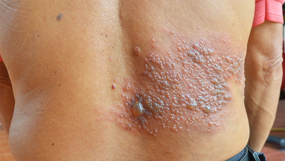 herpes zoster causado pelo virus da catapora pode ser prevenido com vacinacao herpes zoster divulgacao