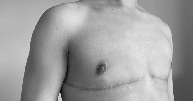 sean92shutterstock mastectomia article 1