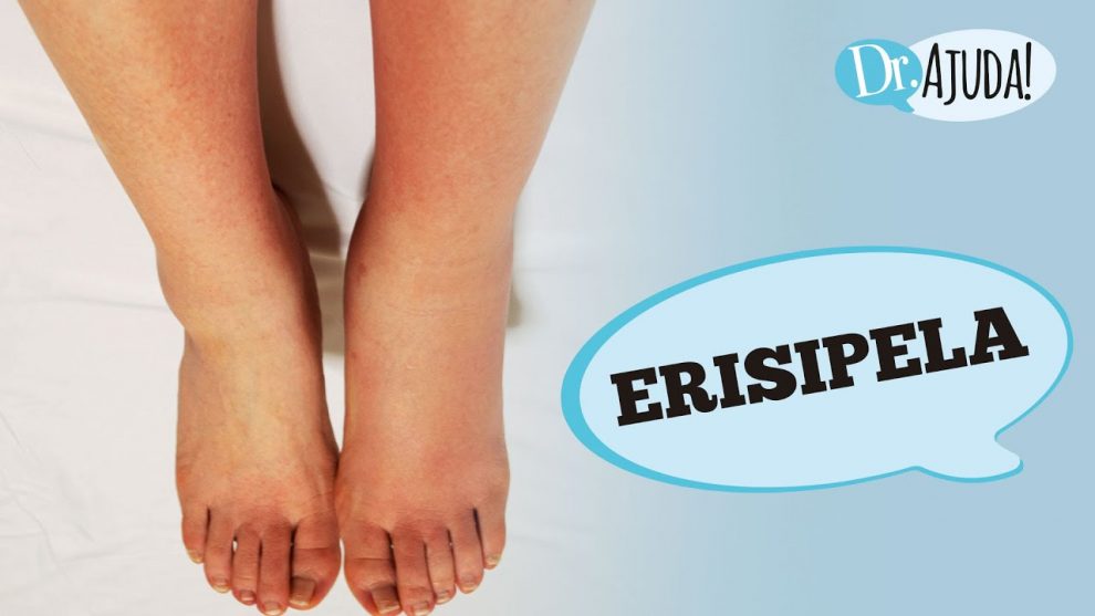 o que e erisipela qual e a causa e os sintomas erisipela