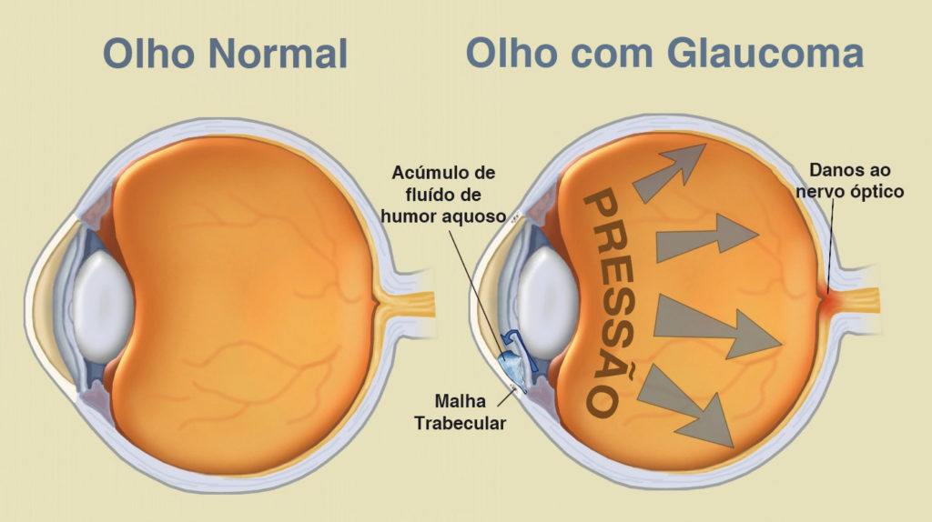 maio verde mobilizacao para a prevencao e combate ao glaucoma image