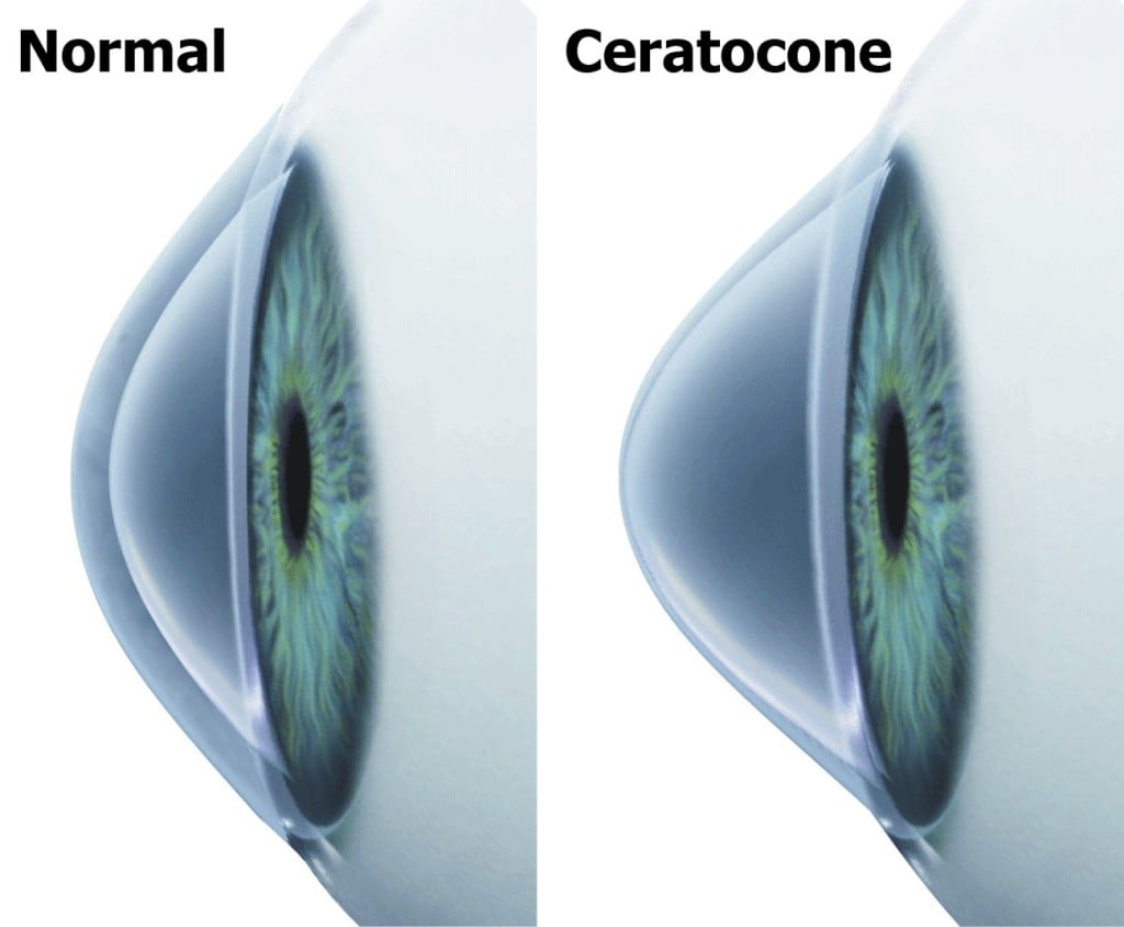 ceratocone a ameaca invisivel que pode tirar a sua visao image