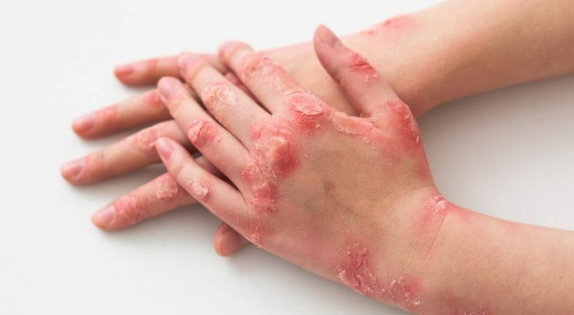 psoriase 1 psoriase 1