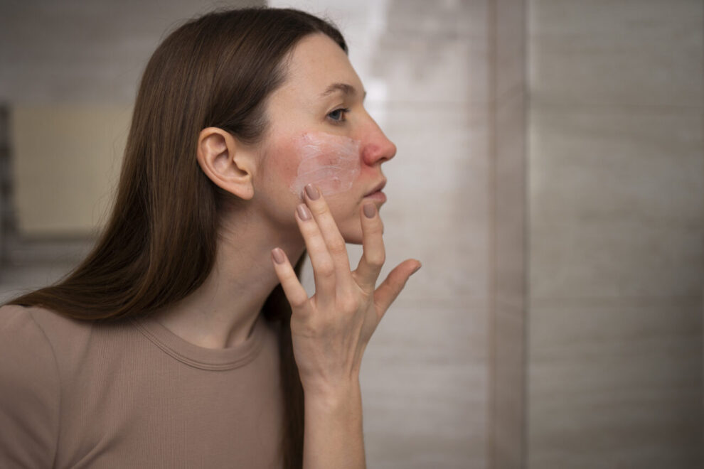 rosacea condicao de pele piora no inverno e pode ser confundida com acne foto freepik