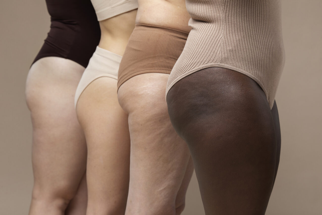 lipedema o corpo fala e a dor pede escuta mulheres diferentes juntas