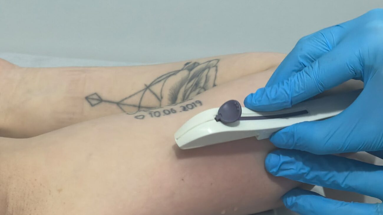 cocal do sul passa a oferecer implante anticoncepcional gratuito pelo sus cocal do sul passa a oferecer implante anticoncepcional gratuito pelo sus