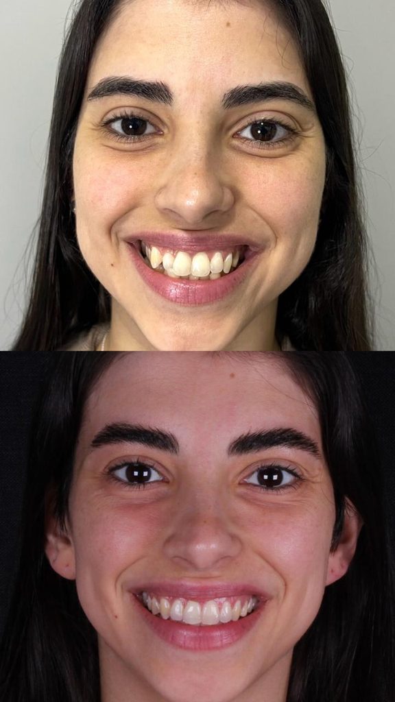 alinhadores invisiveis unem estetica conforto e tecnologia para transformar sorrisos whatsapp image 2026 08 25 at 19.01.14 1 576x1024 alinhadores invisiveis unem estetica conforto e tecnologia para tr