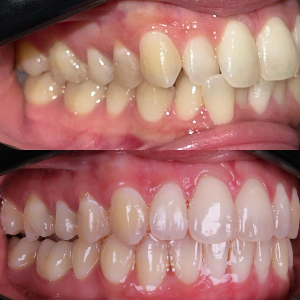 alinhadores invisiveis unem estetica conforto e tecnologia para transformar sorrisos whatsapp image 2026 08 25 at 19.01.14 2 1024x1024 alinhadores invisiveis unem estetica conforto e tecnologia para t