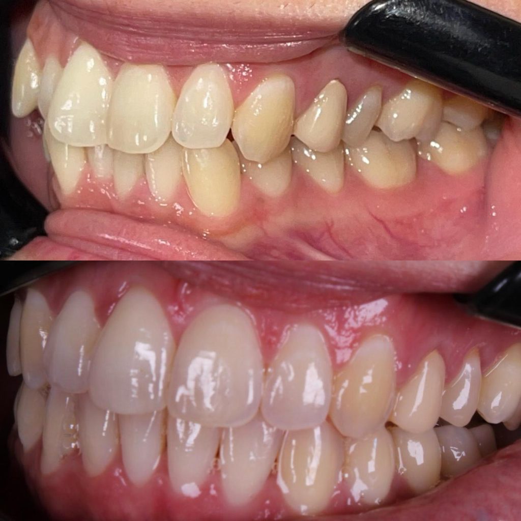 alinhadores invisiveis unem estetica conforto e tecnologia para transformar sorrisos whatsapp image 2026 08 25 at 19.01.14 3 1024x1024 alinhadores invisiveis unem estetica conforto e tecnologia para t