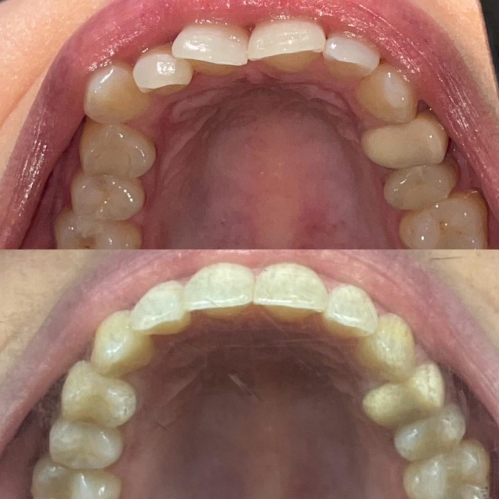 alinhadores invisiveis unem estetica conforto e tecnologia para transformar sorrisos whatsapp image 2026 08 25 at 19.01.14 4 1024x1024 alinhadores invisiveis unem estetica conforto e tecnologia para t